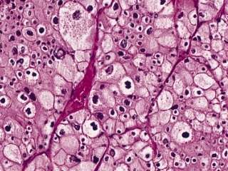 Image:Renal Cell Carcinoma.jpg