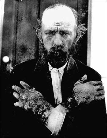 Image:Pellagra NIH.jpg