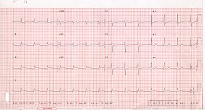 12-lead electrocardiogram (ECG) showing acute inferior ST segment elevation MI (STEMI). Note the ST segment elevation in leads II, III, and aVF along with reciprocal ST segment depression in leads I and aVL.