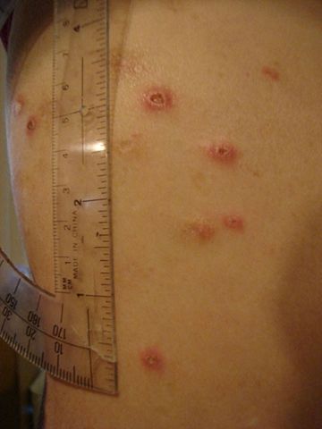 Image:Crohnie sores 4.JPG