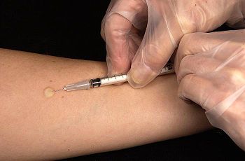 Mantoux tuberculin skin test
