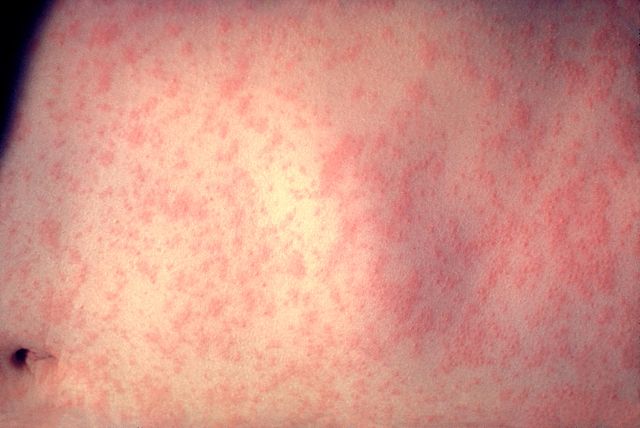 Image:Morbillivirus measles infection.jpg